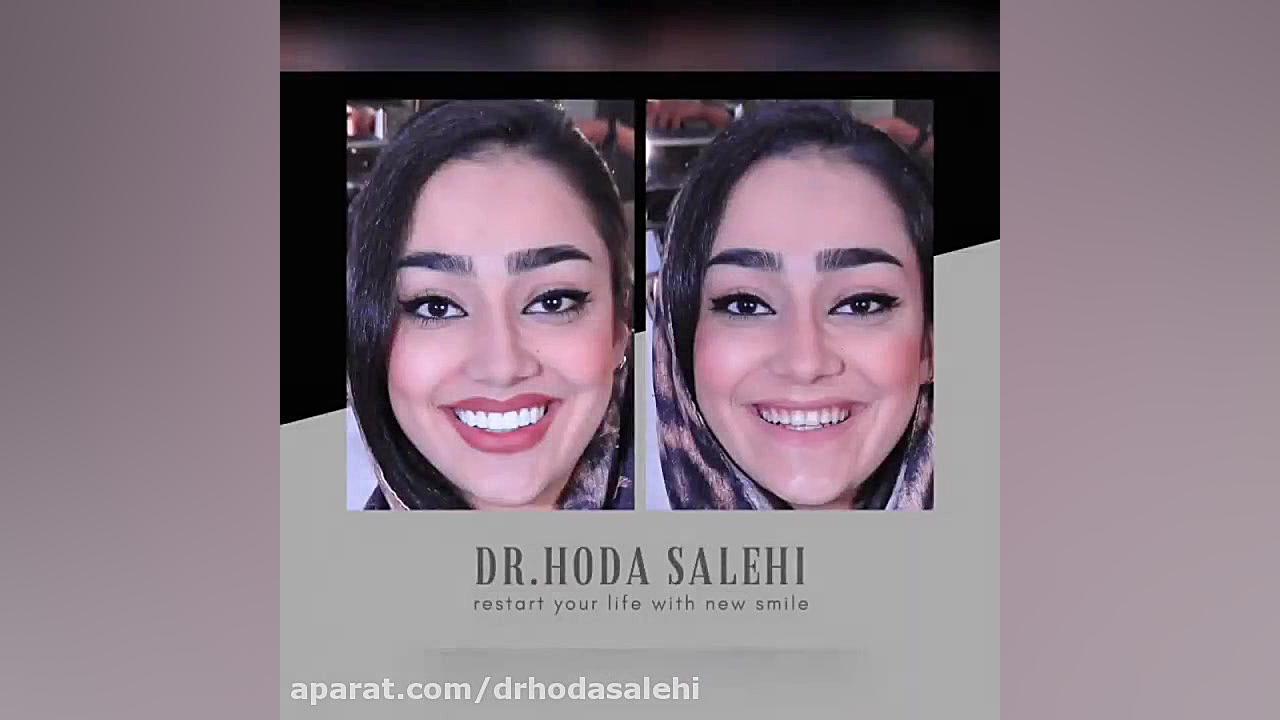 ونیر کامپوزیت دندان ها ی فک بالا در اصفهان | دکتر هدی صالحی دکتر هدی صالحی| دندانپزشک زیبایی در اصفهان