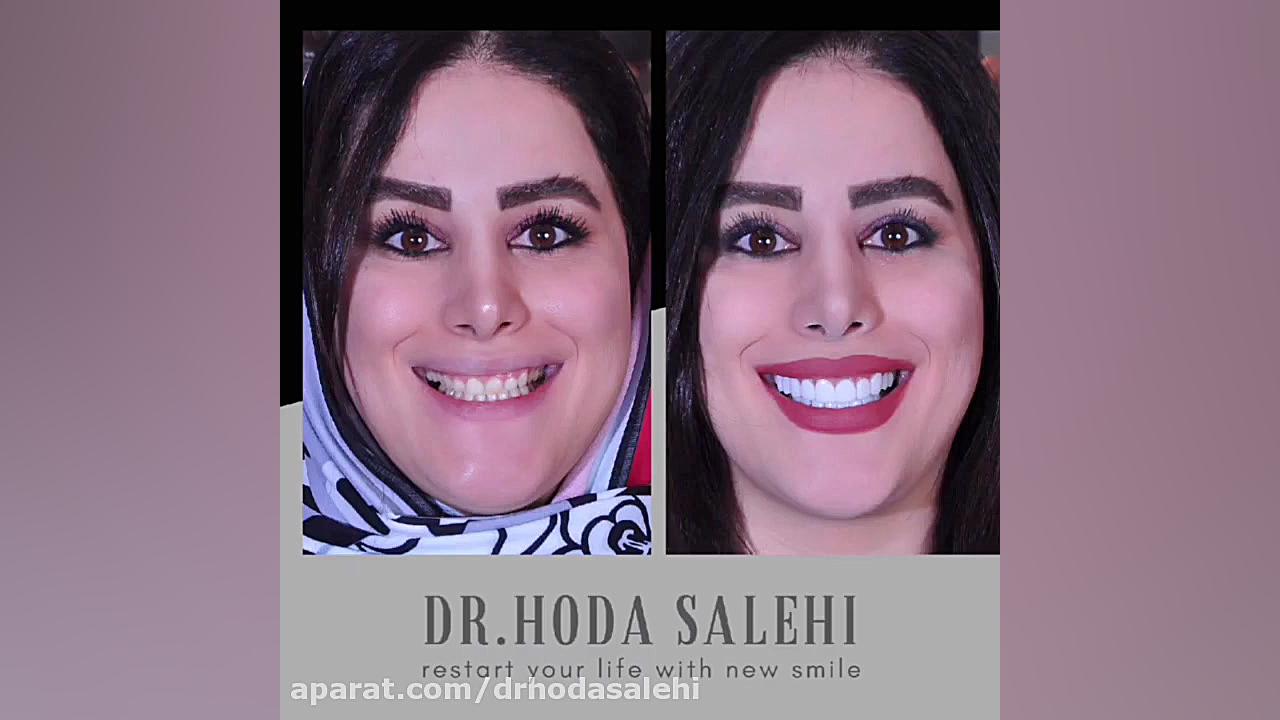 اصلاح لبخند لثه ای در اصفهان |ونیر کامپوزیت و اصلاح طرح لبخند کاپوت سکودانئوم