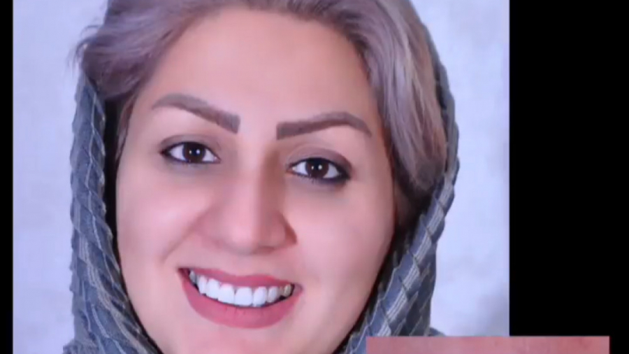 ونیر کامپوزیت دندان های فک بالا | دکتر هدی صالحی | اصفهان دکتر هدی صالحی| دندانپزشک زیبایی در اصفهان