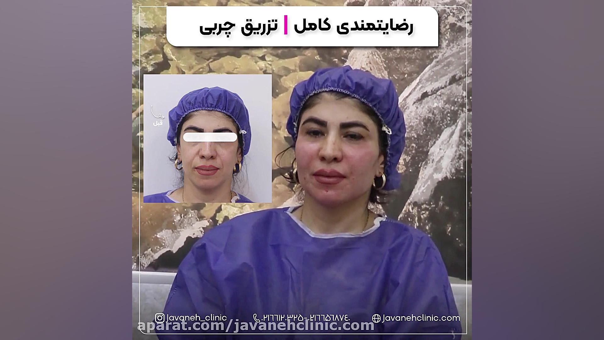 رضایتمندی تزریق چربی ربات جراحی داوینچی