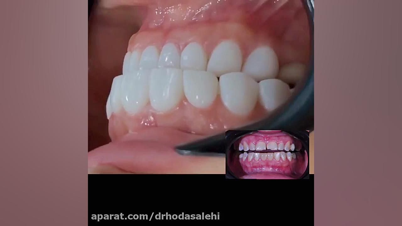 اصلاح لبخند دندان های بالا و پایین با استفاده از ونیر کامپوزیت | دکتر هدی صالحی دکتر هدی صالحی| دندانپزشک زیبایی در اصفهان