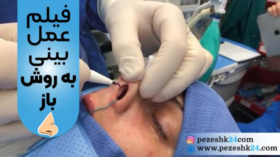 فیلم عمل بینی به روش باز در اتاق عمل (فیلم واقعی) کربوکسی تراپی