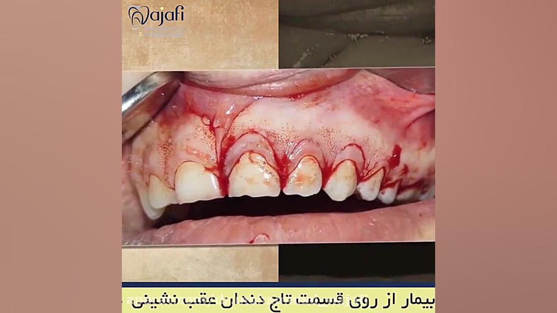 اصلاح لبخند لثه ای بیماری بهجت