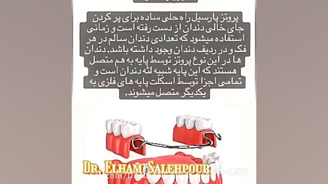 بریج دندان چیست پل گذاری دندان باندینگ دندان چیست پروتز دندان ثابت و متحرک برداشتن خال گوشتی