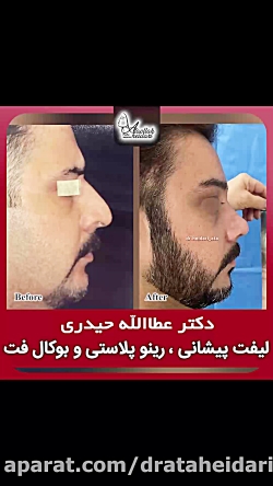لیفت پیشانی ، رینوپلاستی و جراحی بوکال فت
