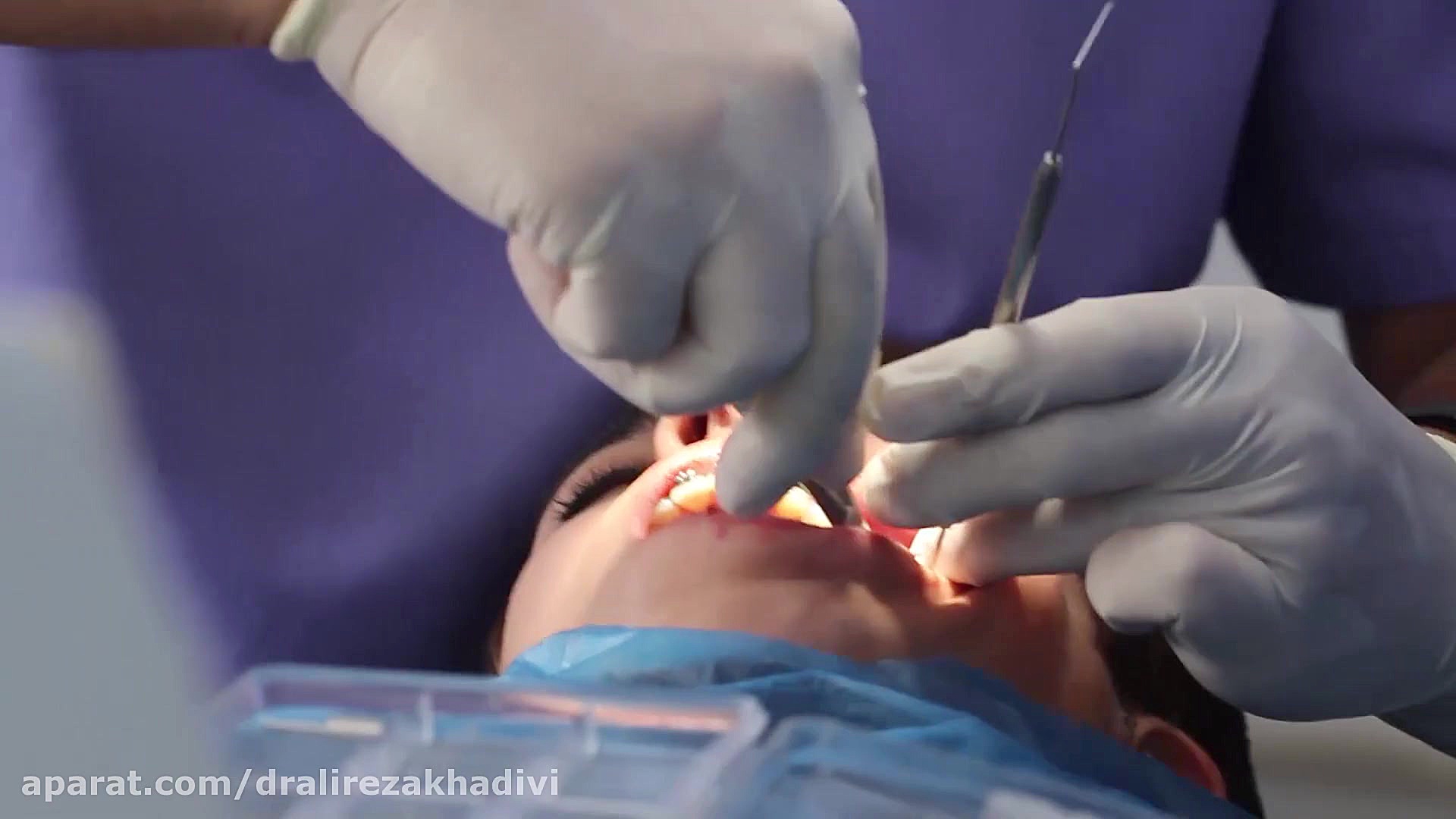 درمان ارتودنسی با استفاده از مینی اسکرو.دکترعلیرضاخدیوی متخصص ارتودنسی دکتر علیرضا خدیوی