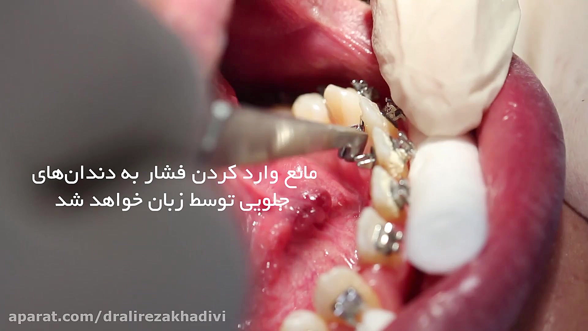 دستگاه عادت شکن زبان.متخصص ارتودنسی تهران دکتر علیرضا خدیوی دکتر علیرضا خدیوی