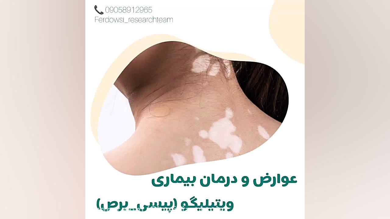 عوارض و درمان قطعی بیماری پیسی یا ویتیلیگو در طب سنتی امیر جدیدی