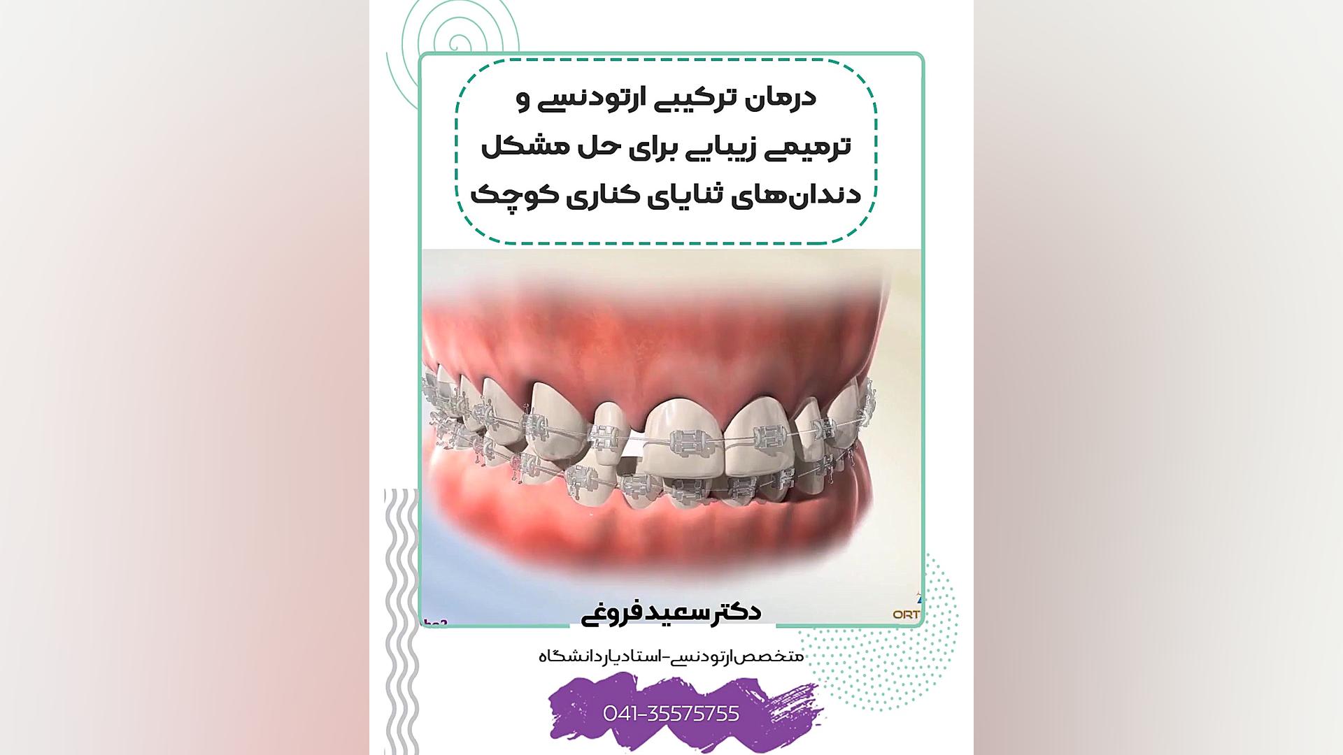 درمان ترکیبی ارتودنسی و ترمیمی زیبایی برای حل مشکل دندانهای ثنایای کناری کوچک دکتر سعید فروغی متخصص ارتودنسی