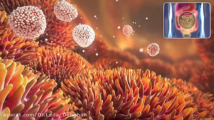 دیالیز کلیه کله عنکبوت