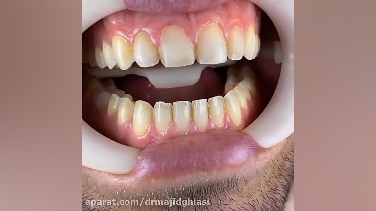 اصلاح طرح لبخند دکترمجیدقیاسی