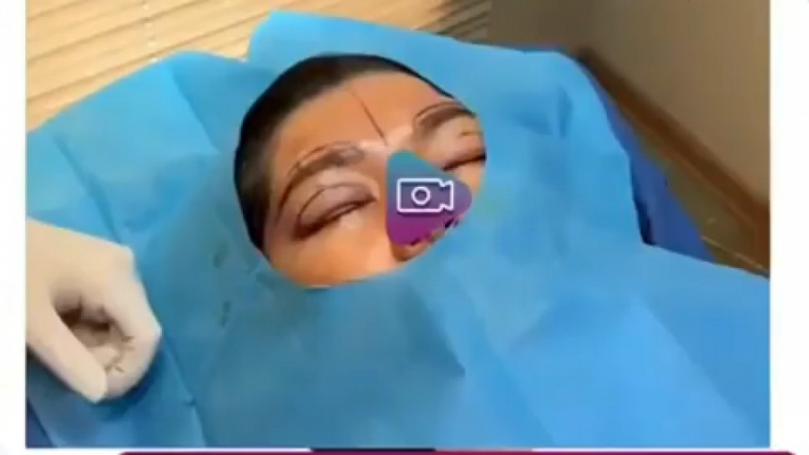 لیفت همزمان پلک و ابرو با بی حسی موضعی مزوتراپی