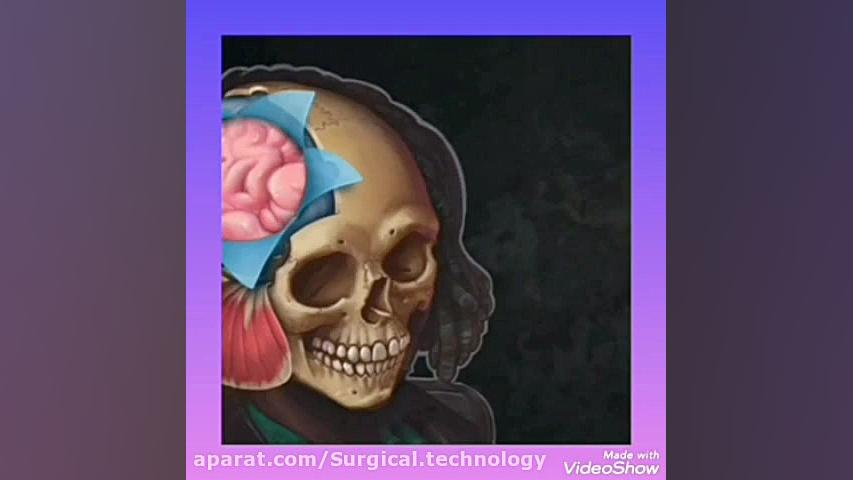 جراحی هماتوم ساب دورال حاد(دانشگاه علوم پزشکی شهرکرد) ترمیم لبخند لثه‌ای