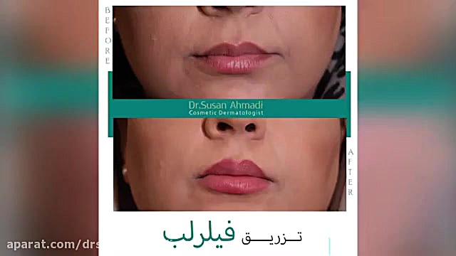 ️تزريق فيلر لب طبیعی️ دکتر سوسن احمدی پیر شهید