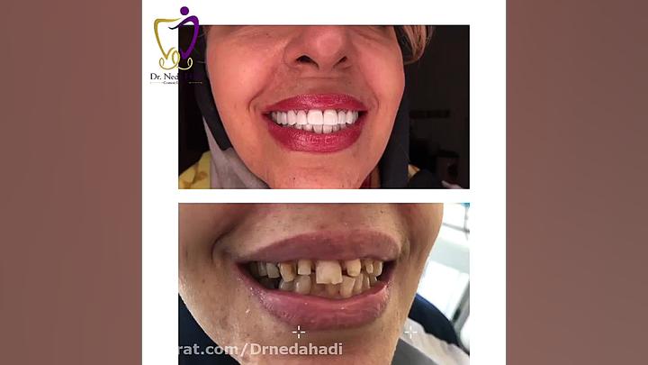 با ما لبخندی زیبا و جذاب داشته باشید دکتر ندا هادی-دندانپزشک زیبایی