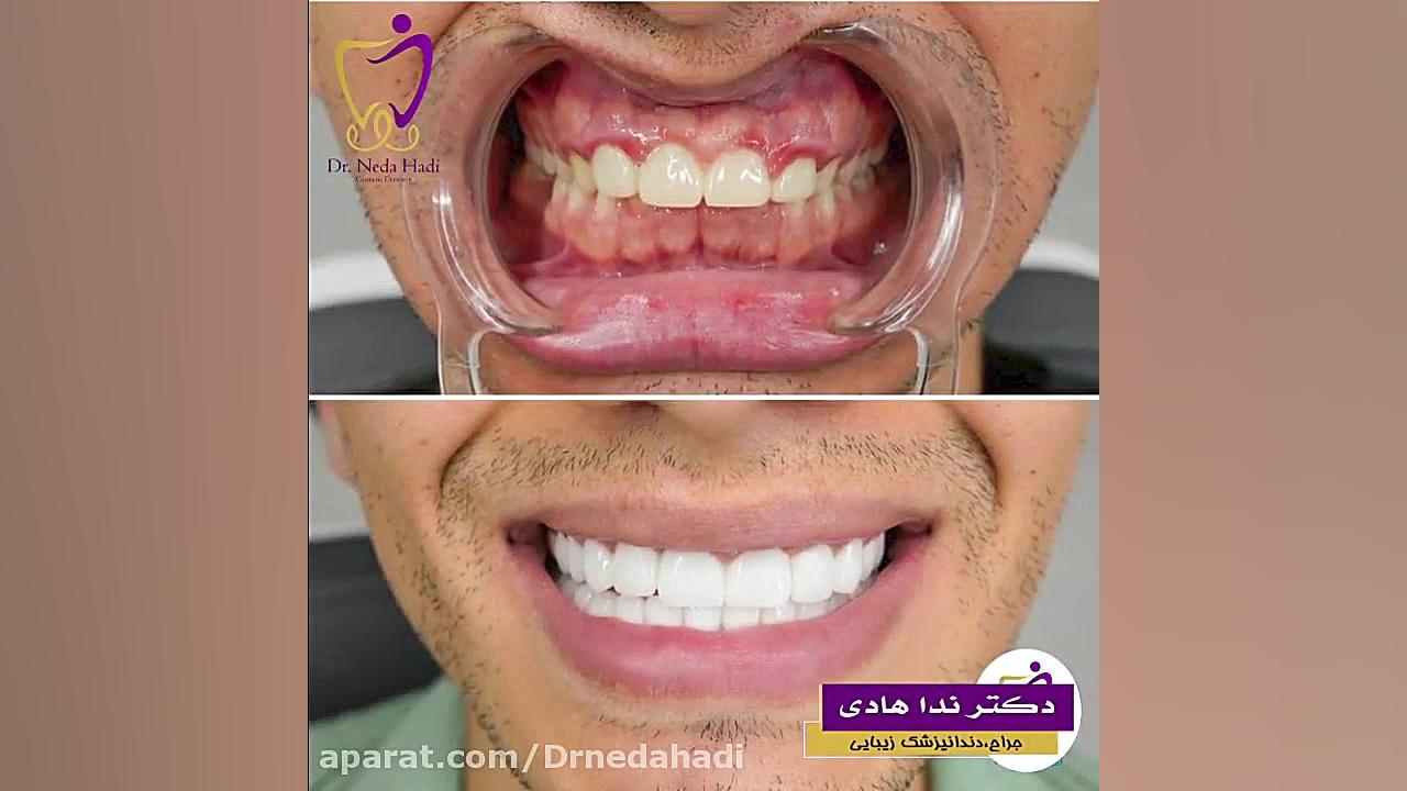 فیلم واقعی لمینت دندان دکتر ندا هادی-دندانپزشک زیبایی