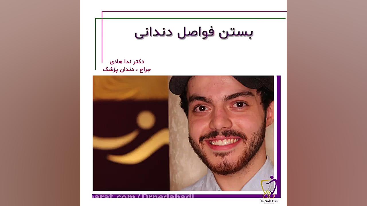 بستن فواصل بین دندانها با کامپوزیت هم رنگ دندان مراجعه کننده دکتر ندا هادی-دندانپزشک زیبایی