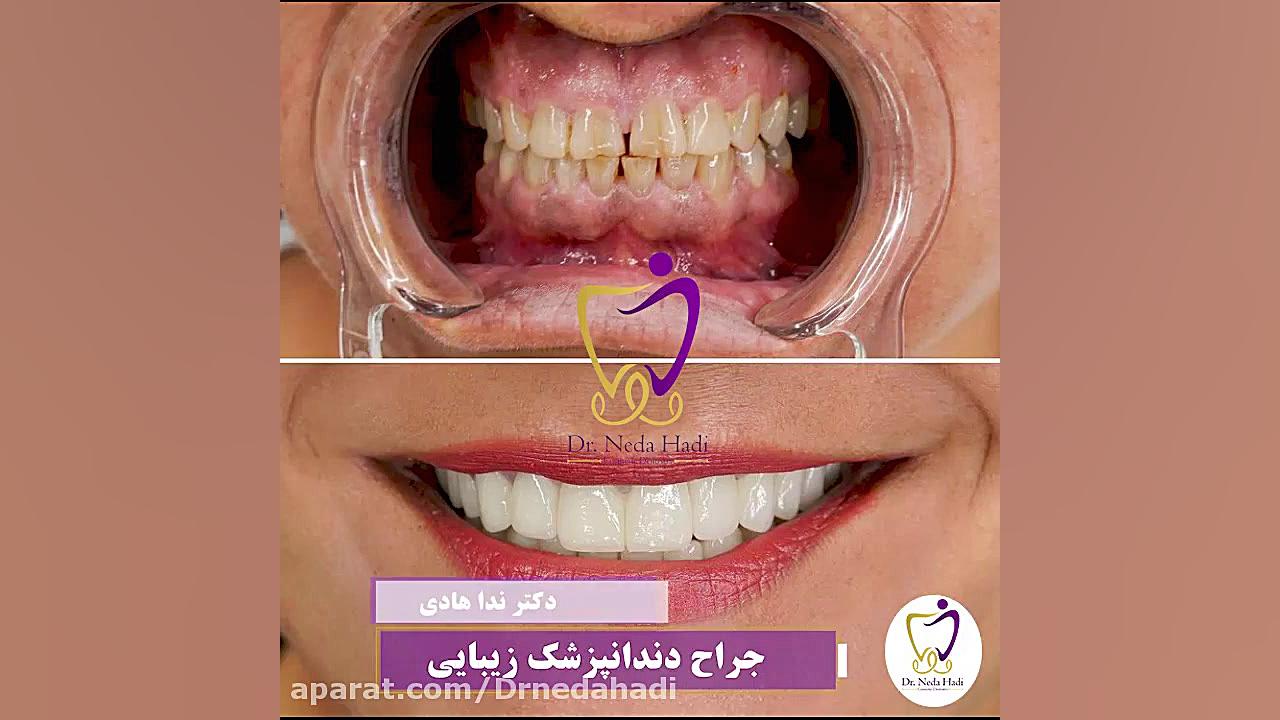 فیلم واقعی لمینت هر دو فک در مطب دکتر ندا هادی-دندانپزشک زیبایی