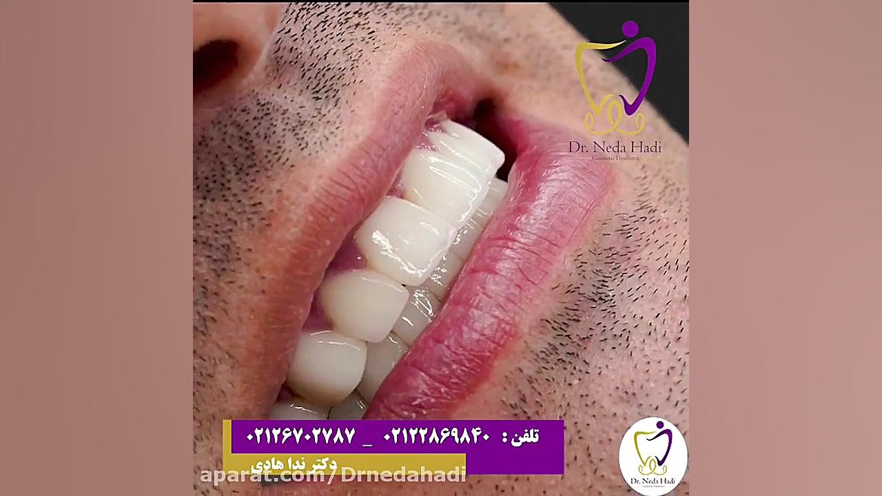 فیلم لمینت هر دو فک زیباجو دکتر ندا هادی-دندانپزشک زیبایی