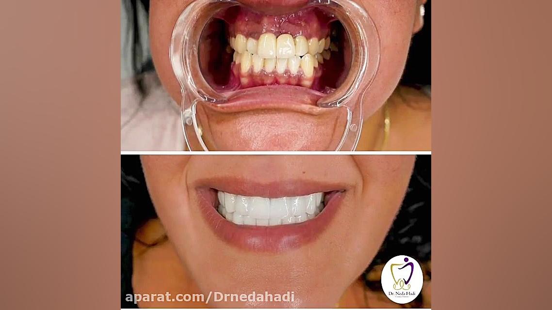لمینیت دو فک بالا و پایین دکتر ندا هادی-دندانپزشک زیبایی