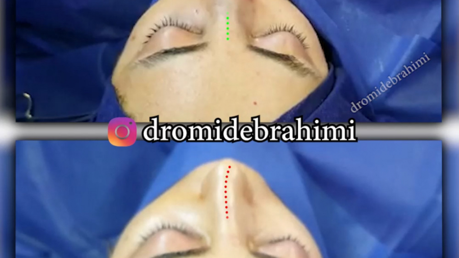 جراحی زیبایی بینی انحراف دار، توسط دکتر امید ابراهیمی بهترین جراح بینی در تهران دکتر امید ابراهیمی