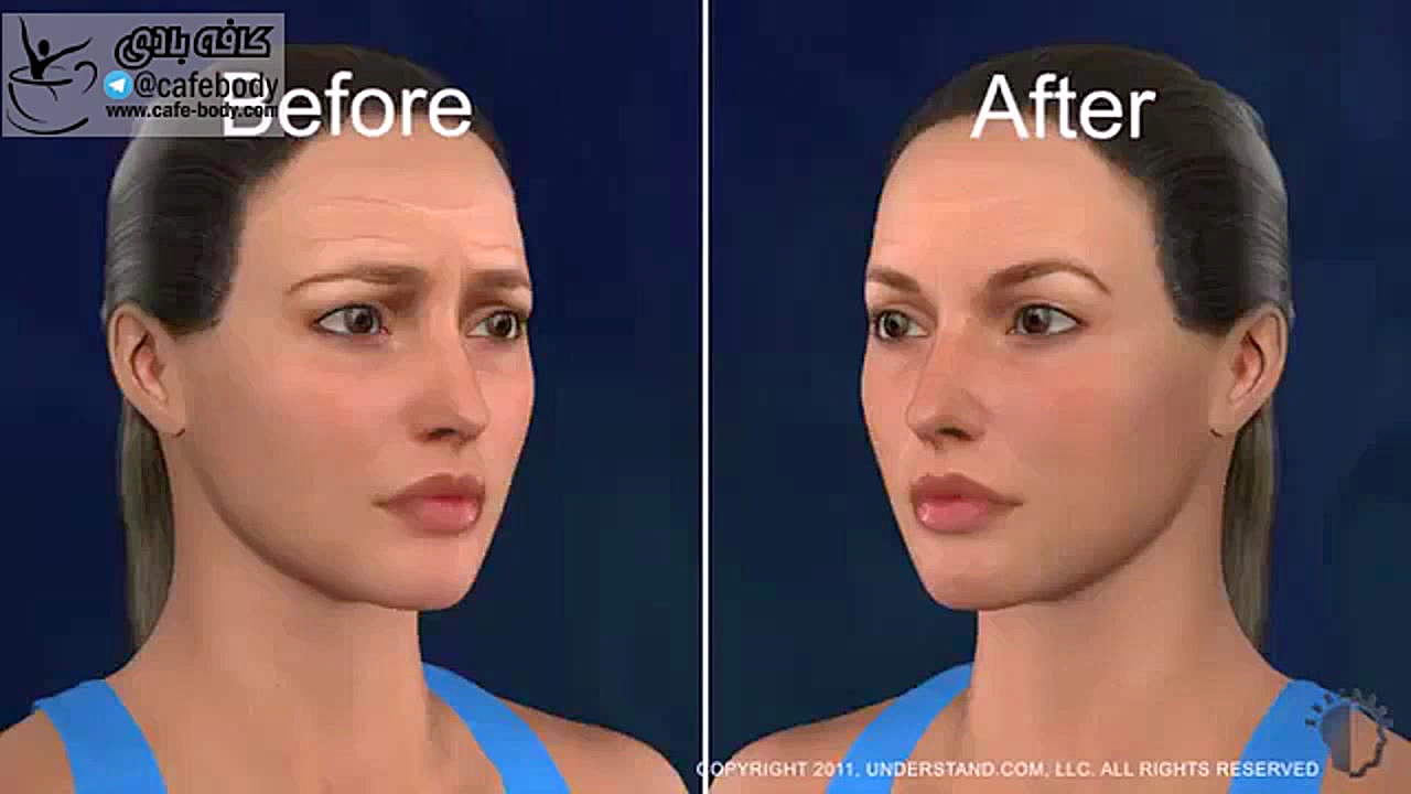 لیفت ابرو (Brow Lift) pO2