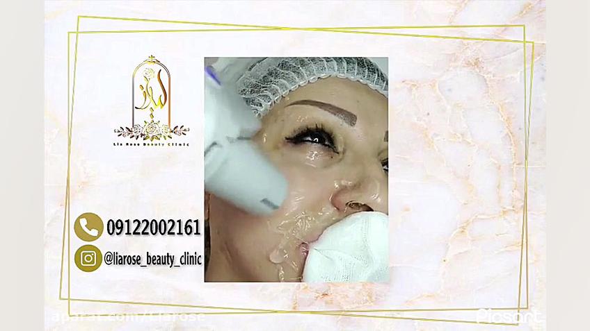 هایفوتراپی در کلینیک لیارز لیزر موهای زائد