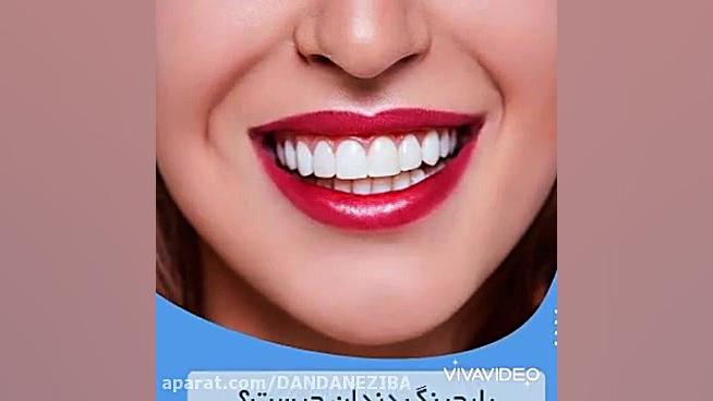 بلیچینگ دندان قیمت بلیچینگ دندان فیلم بلیچینگ دندان ریتوکسیمب-هایبرید