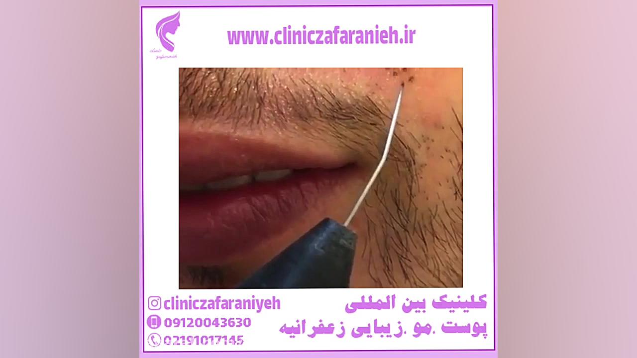 کاربرد مزایا و نتایج حیرت‌آور پلاسما جت لباس اگزواسکلتون پزشکی