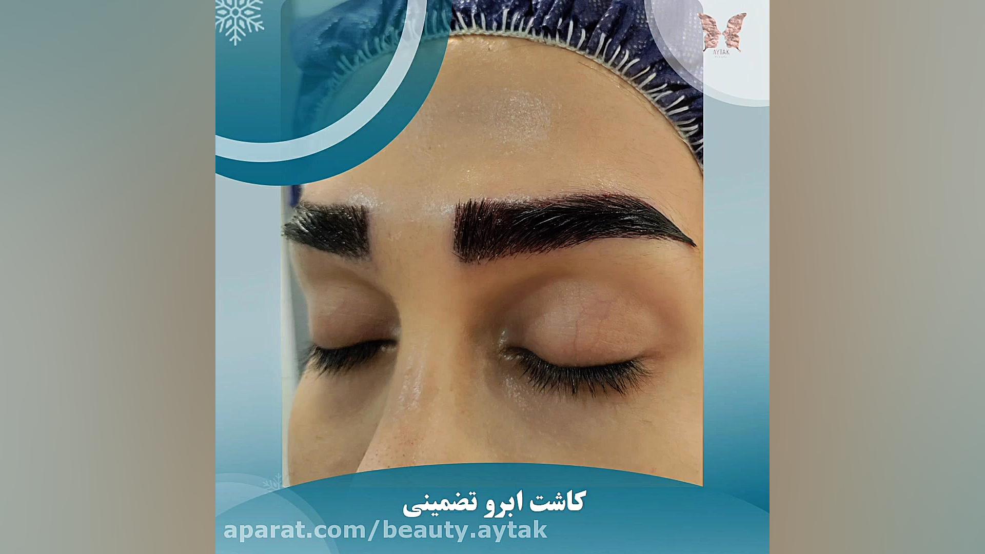 فیلم پیوند ابرو طبیعی | مرکز کاشت آیتک | رفع چین و چروک
