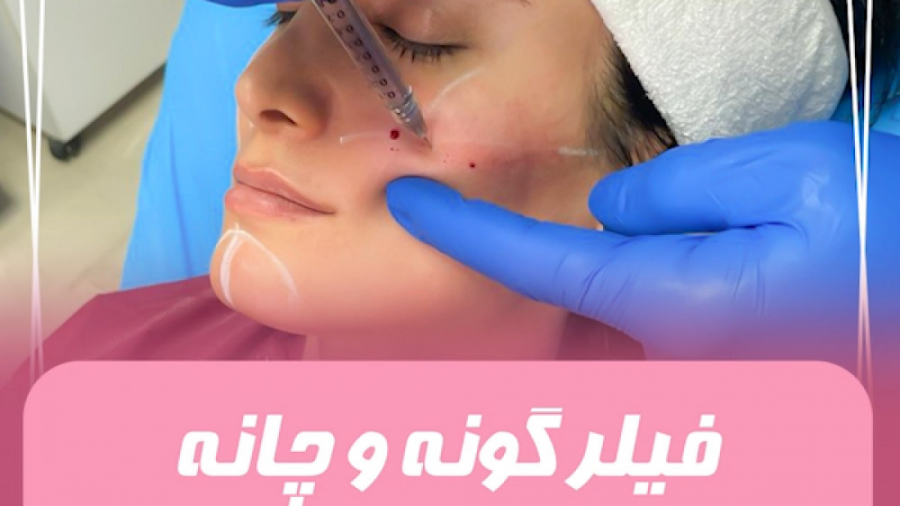 لیفت گونه و چانه و لیفت ابرو وزارتان