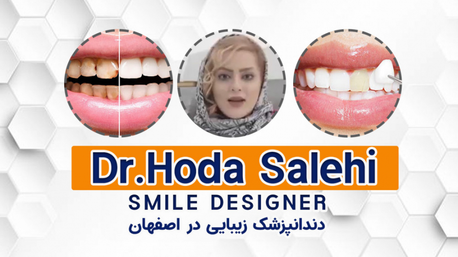 کامپوزیت ونیر چیست ؟ | دکتر هدی صالحی دندانپزشک زیبایی در اصفهان دکتر هدی صالحی| دندانپزشک زیبایی در اصفهان