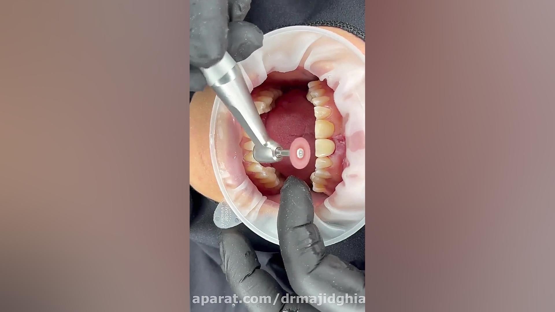 ایمپلنت دندان زیبایی دکترمجیدقیاسی