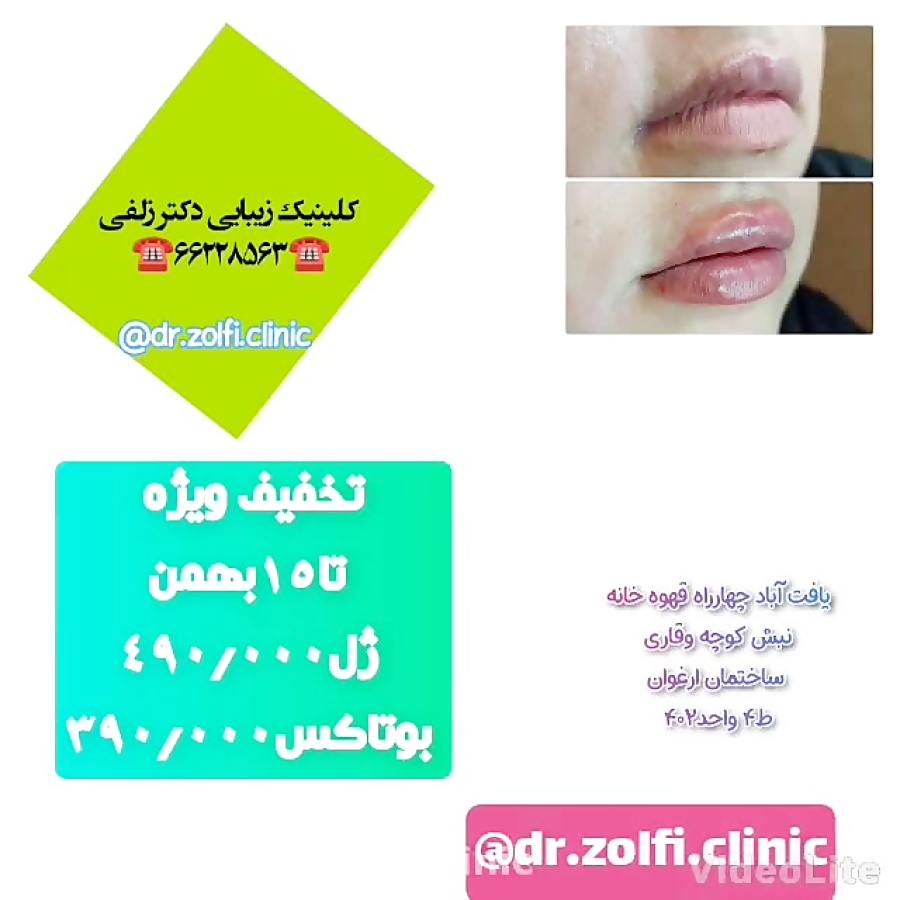 بوتاکس ژل لیفت نخ   دکتر زلفی dr.zolfi.clinic@