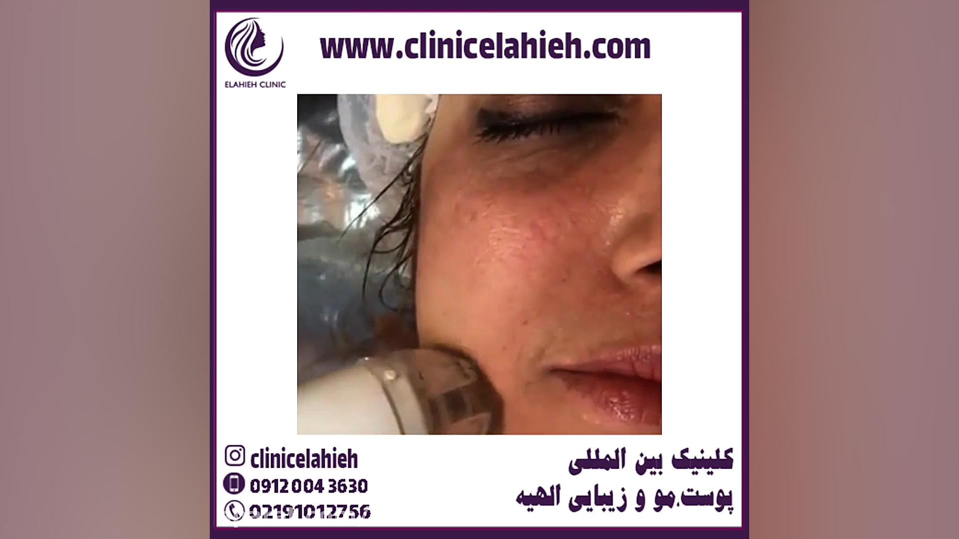 جوانسازی پوست صورت با لیزر آر اف فرکشنال RF Fractional بیولوژی تکوینی