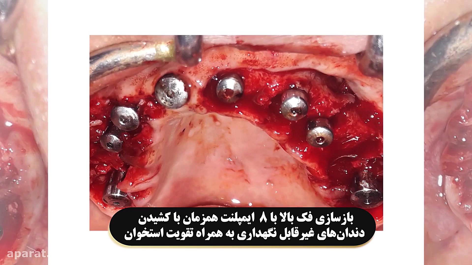 بازسازی فک بالا با کاشت 8 ایمپلنت هم زمان دکتر علی قمری - متخصص جراحی لثه و ایمپلنت