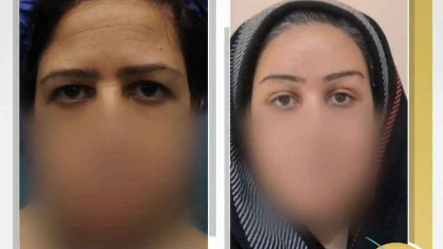 لیفت ابرو با اندوتاین میلوشل