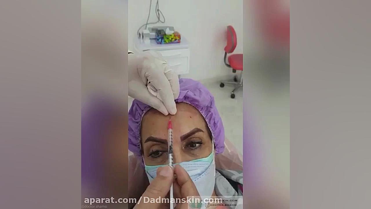 تزریق بوتاکس در ناحیه پیشانی اوتیلومیومبر