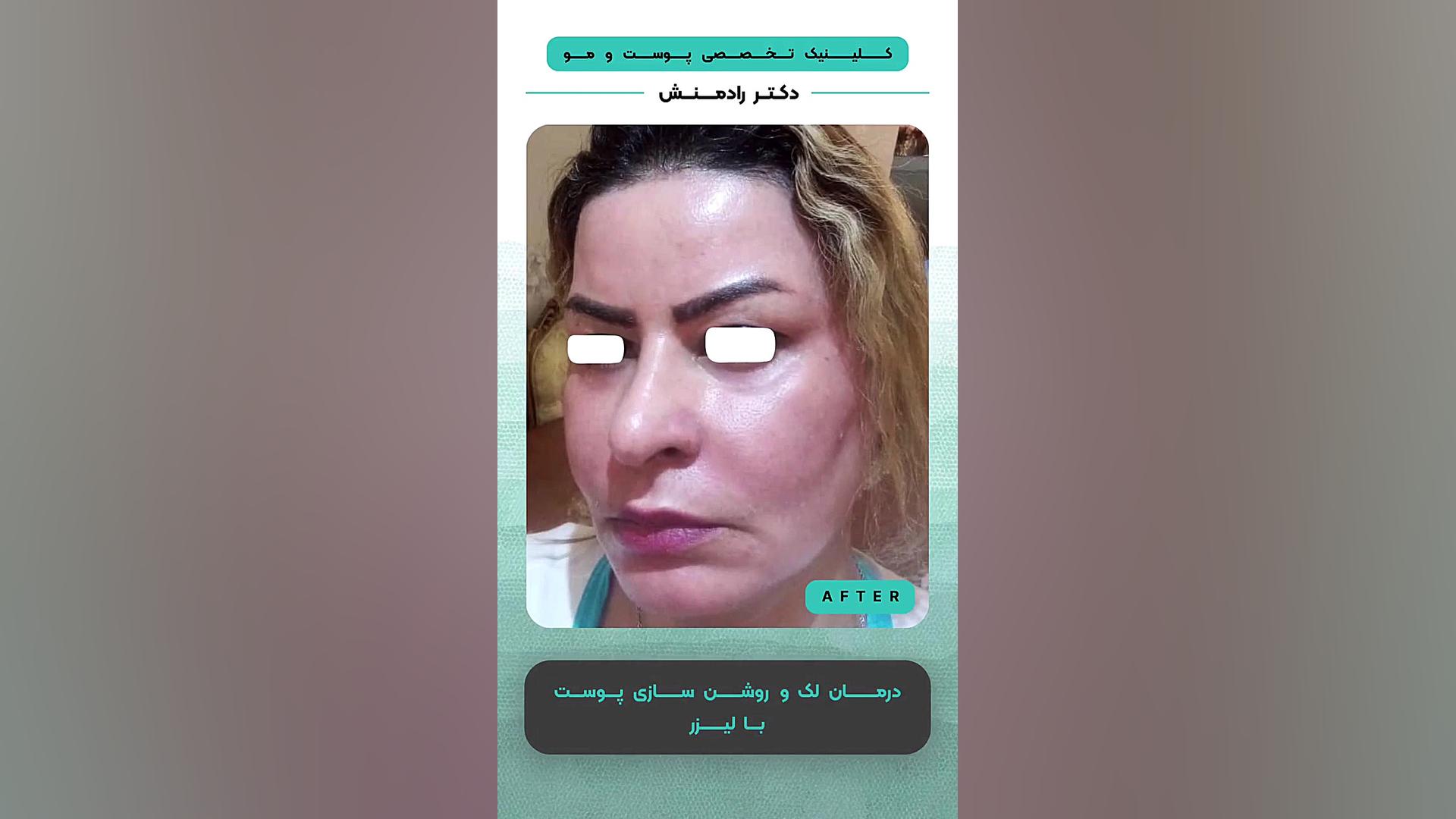 درمان لک و روشن سازی پوست با لیزر لیپوماتیک