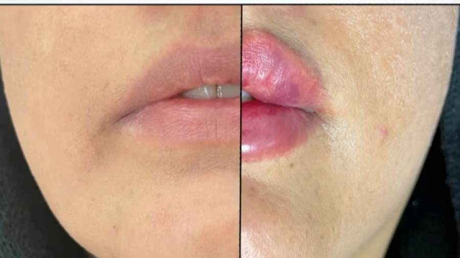 تزریق ژل لب روسی دکتر سار ا لطفی