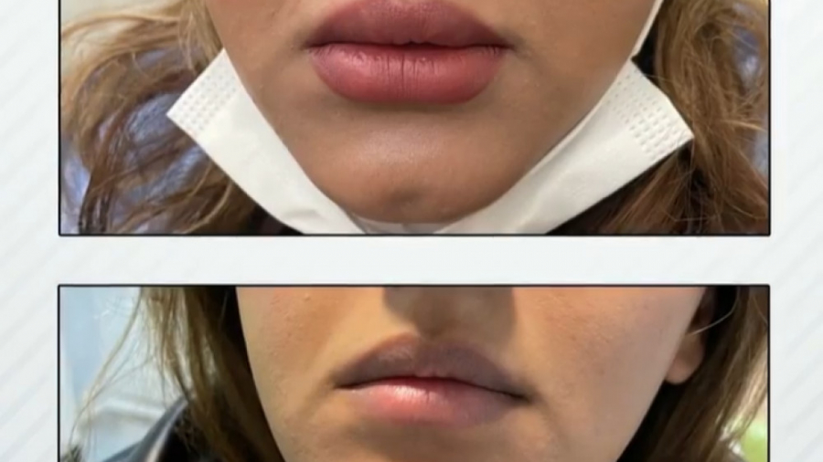 تزریق ژل لب دکتر سار ا لطفی