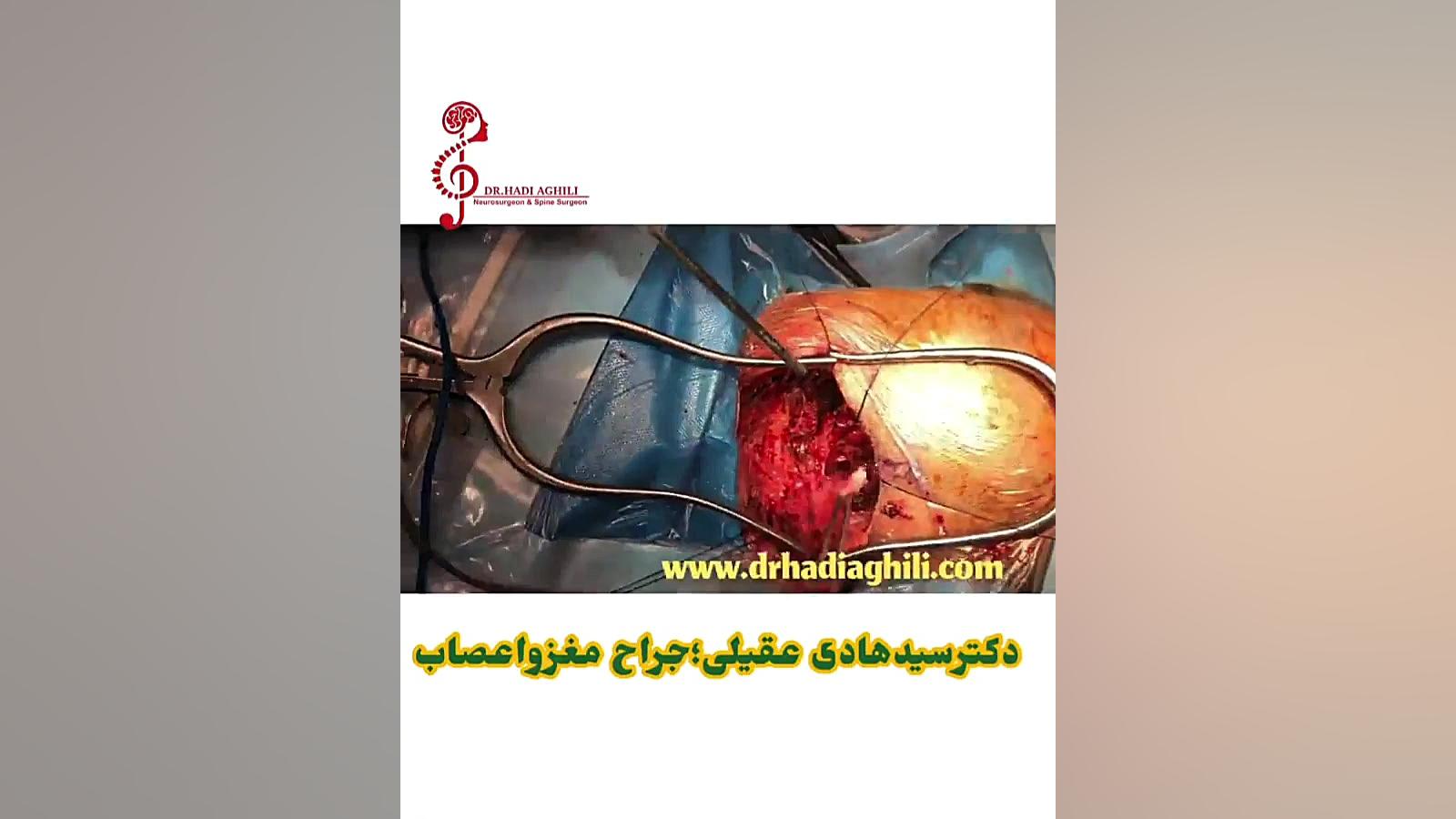 جراحی تومور مخچه دکتر سید هادی عقیلی آهو خمیازه
