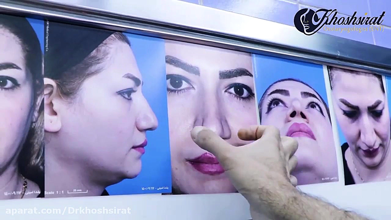 فیلم اتاق عمل جراحی زیبایی بینی (بخش دوم) | دکتر شاهرخ خوش سیرت لیفت پیشانی