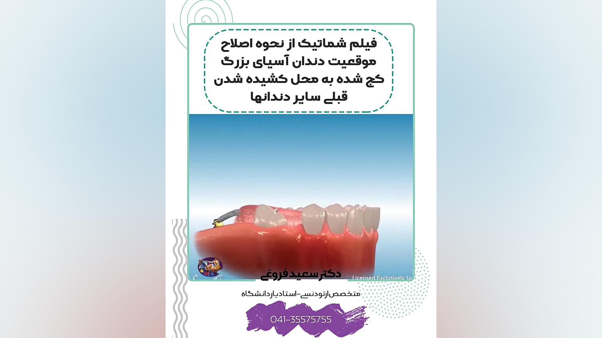 فیلم شماتیک از نحوه اصلاح موقعیت دندان آسیای بزرگ کج شده به محل کشیده شدن قبلی س دکتر سعید فروغی متخصص ارتودنسی