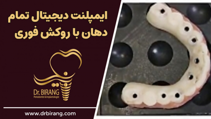 ایمپلنت دیجیتال تمام دهان با روکش فوری در تهران | دکتر احسان بیرنگ دکتر احسان بیرنگ