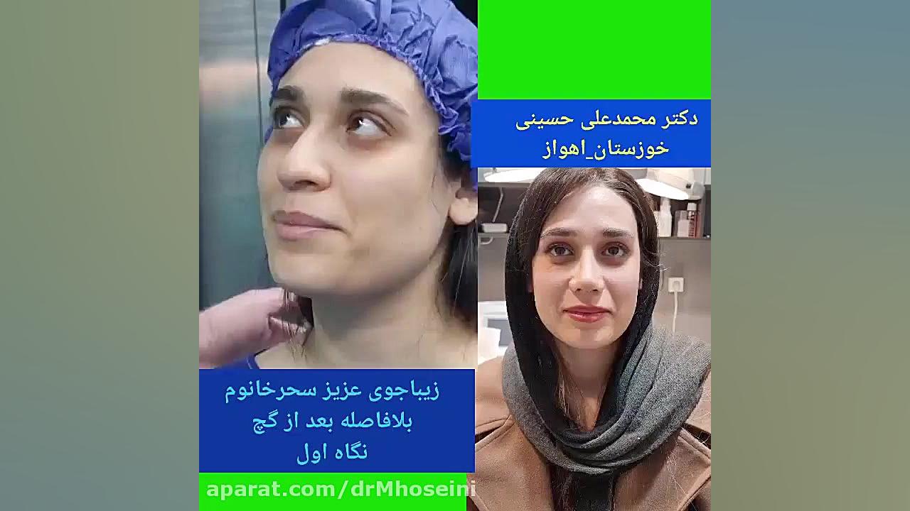 قبل و بعد از عمل زیبایی بینی در اهواز | دکتر محمدعلی حسینی ترمیم سوختگی