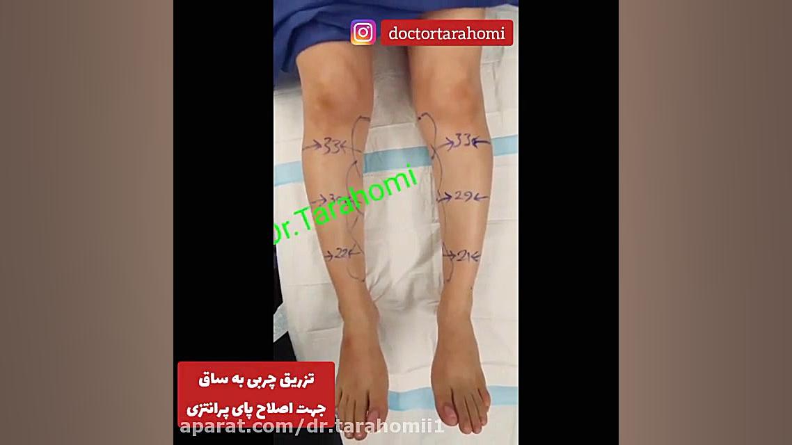 تزریق چربی به ساق جهت اصلاح پای پرانتزی ترمیم سوختگی