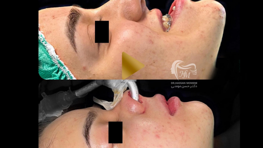 جراحی فک بالا و پایین آزمایش شمارش رتیکولوسیت