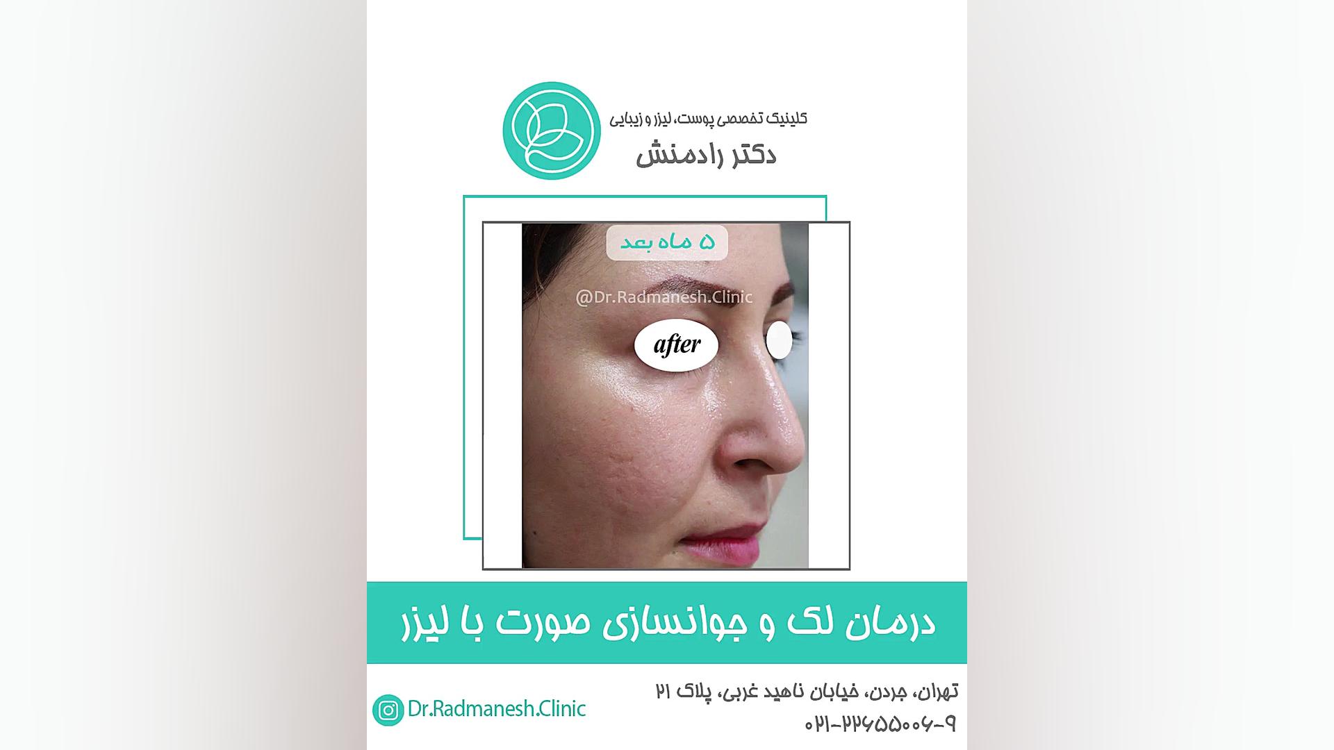 درمان لک و جوانسازی صورت با لیزر ماموپلاستی