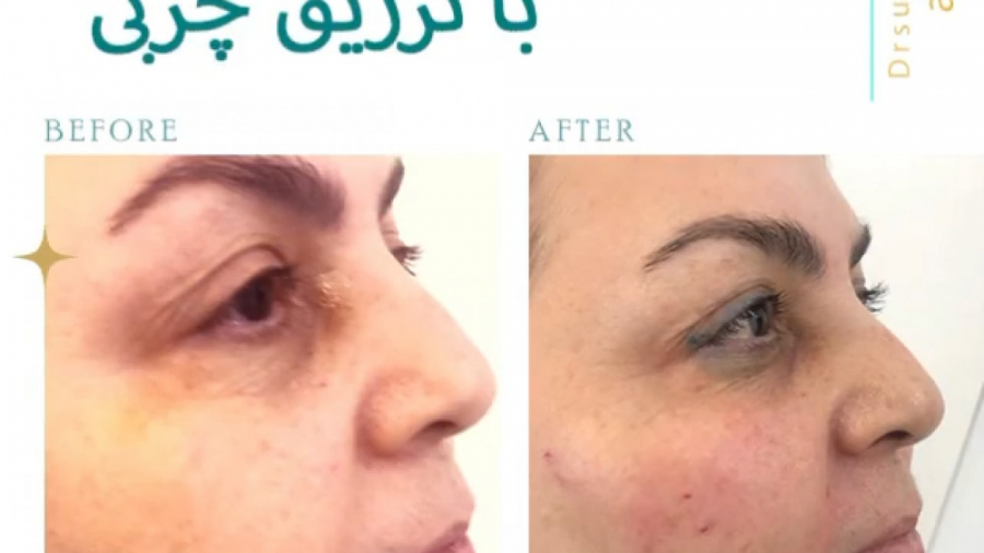فرم دهی و زاویه سازی صورت با تزریق چربی دکتر سوسن احمدی پیر شهید